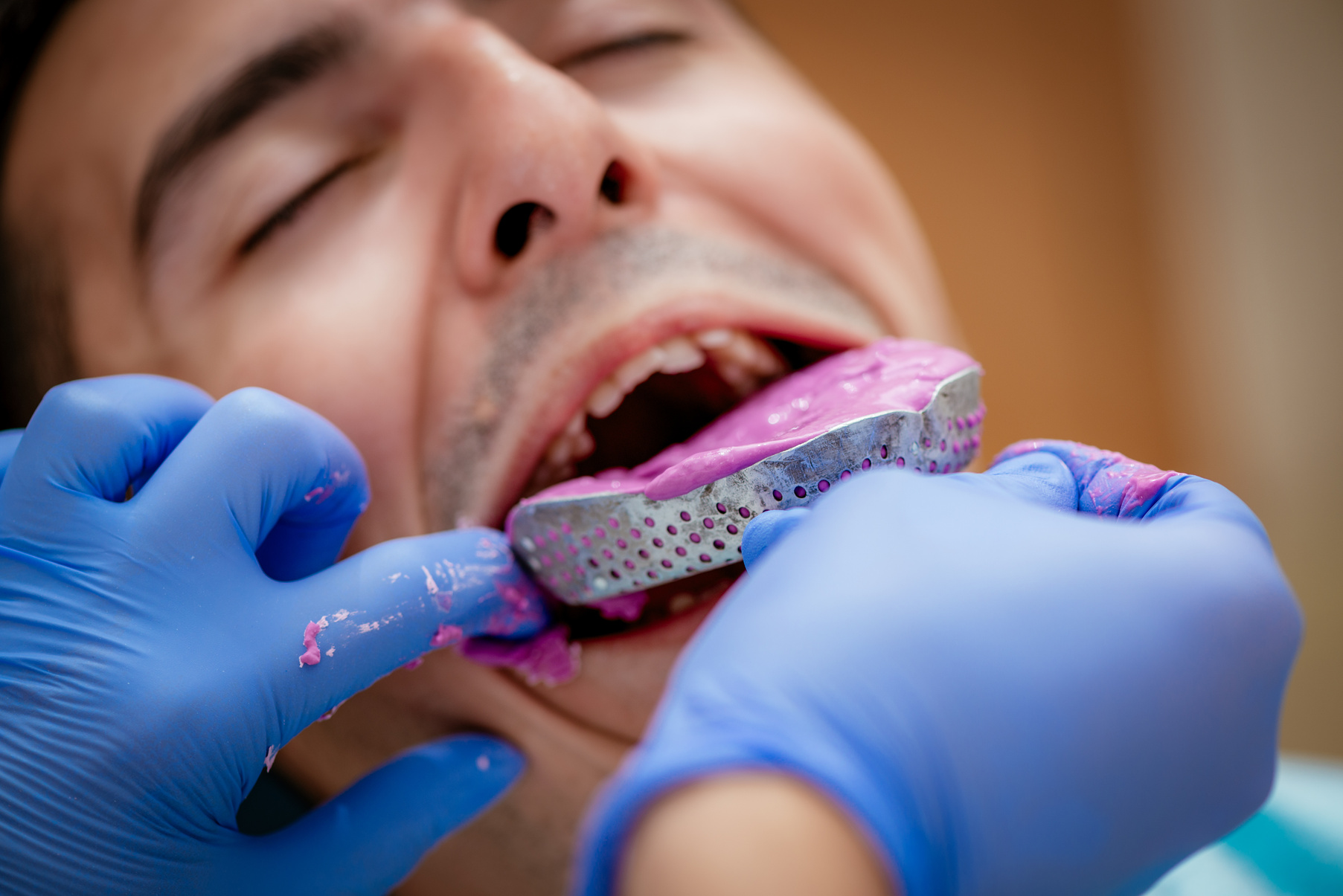 Dental Impression